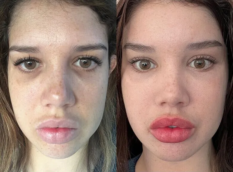 Brow + Forehead Lift before and after photos by Sherber and Rad in Washington, DC