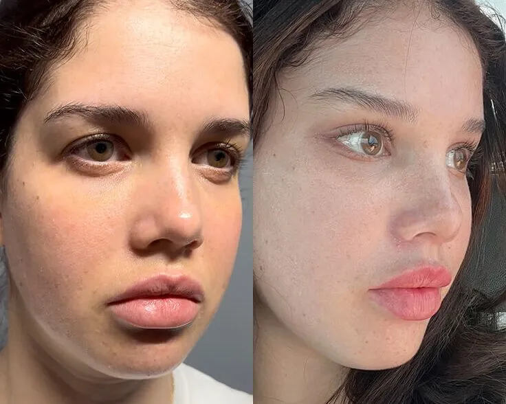 Brow + Forehead Lift before and after photos by Sherber and Rad in Washington, DC