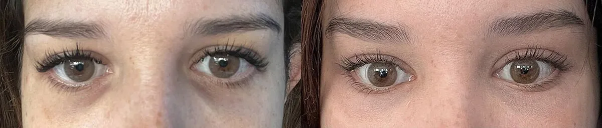 Brow + Forehead Lift before and after photos by Sherber and Rad in Washington, DC