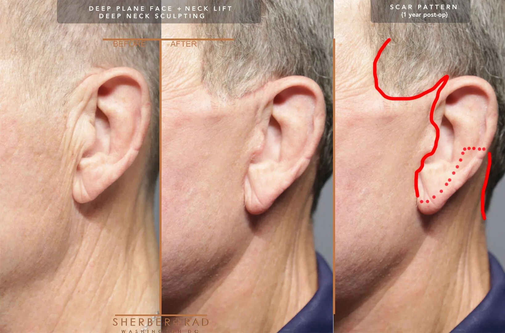 Male Facelift before and after photos by Sherber and Rad in Washington DC