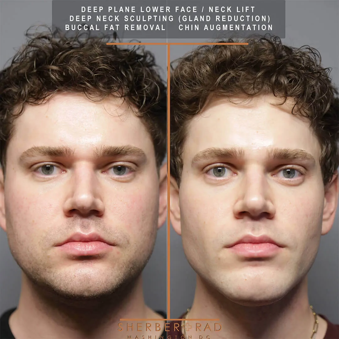 male facelift before and after photos by sherber and rad in washington dc