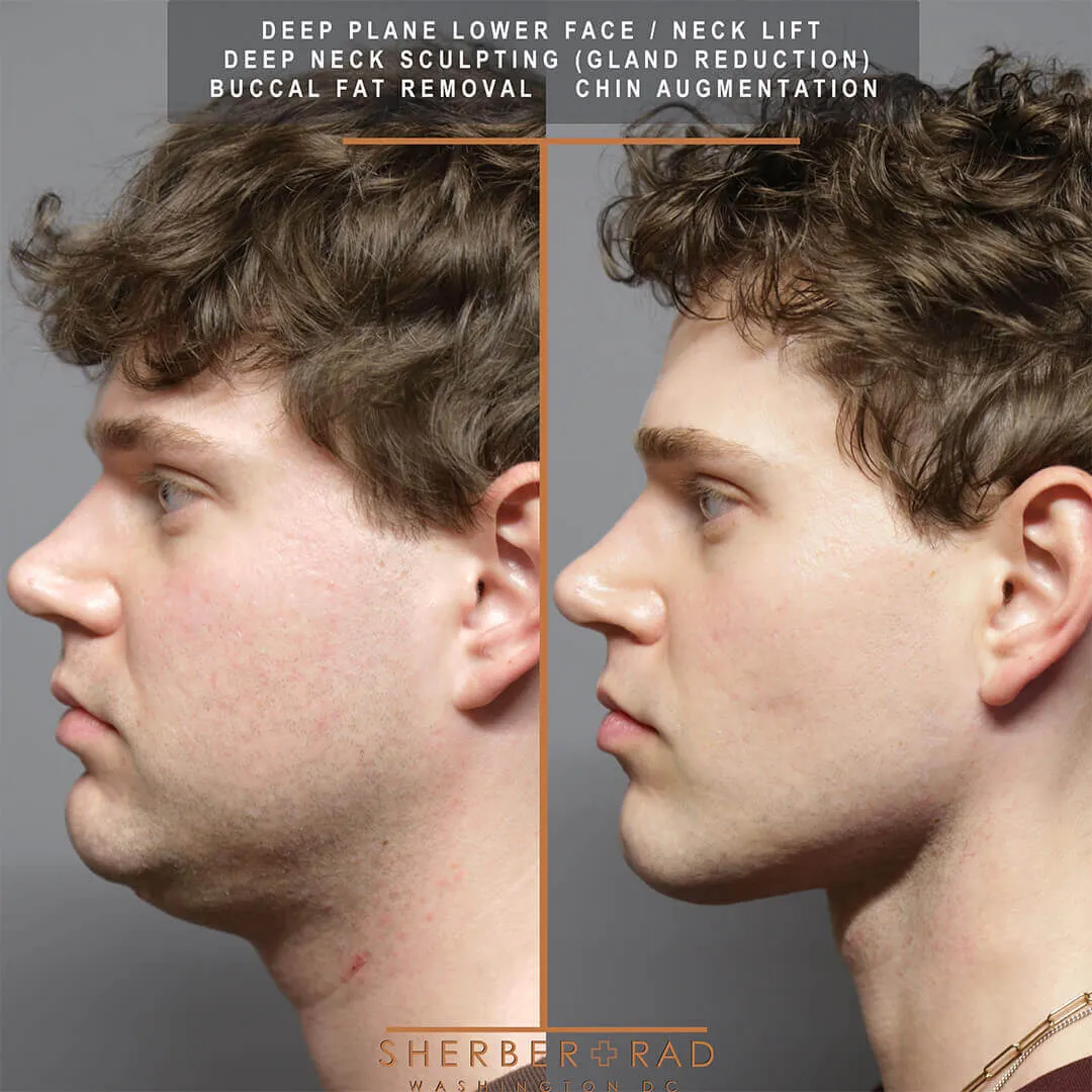 male facelift before and after photos by sherber and rad in washington dc