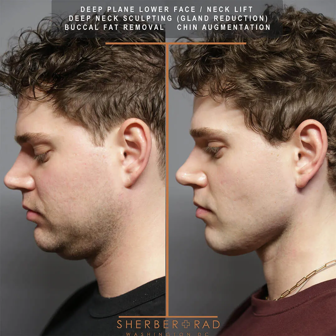 male facelift before and after photos by sherber and rad in washington dc