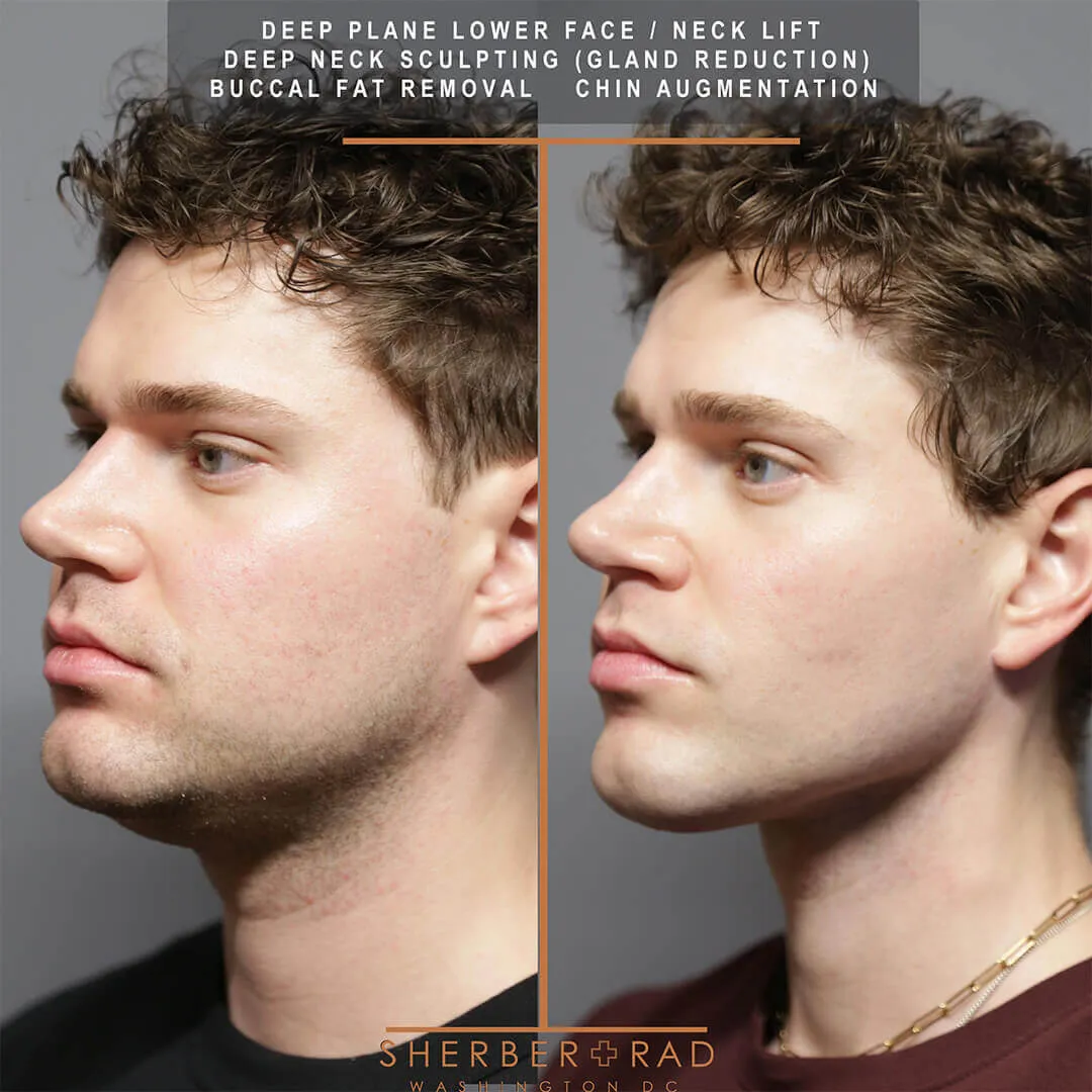 male facelift before and after photos by sherber and rad in washington dc