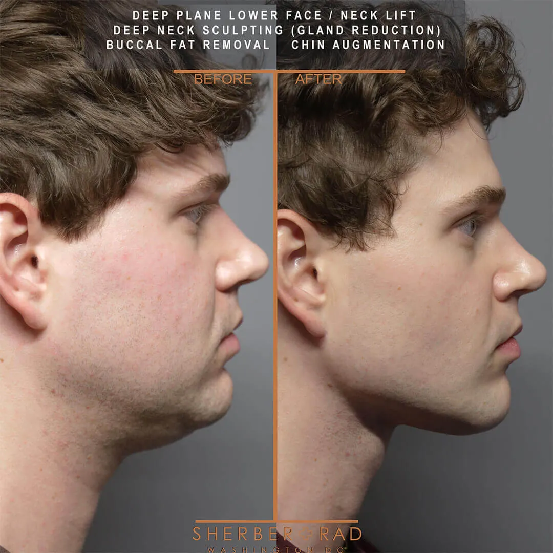 male facelift before and after photos by sherber and rad in washington dc