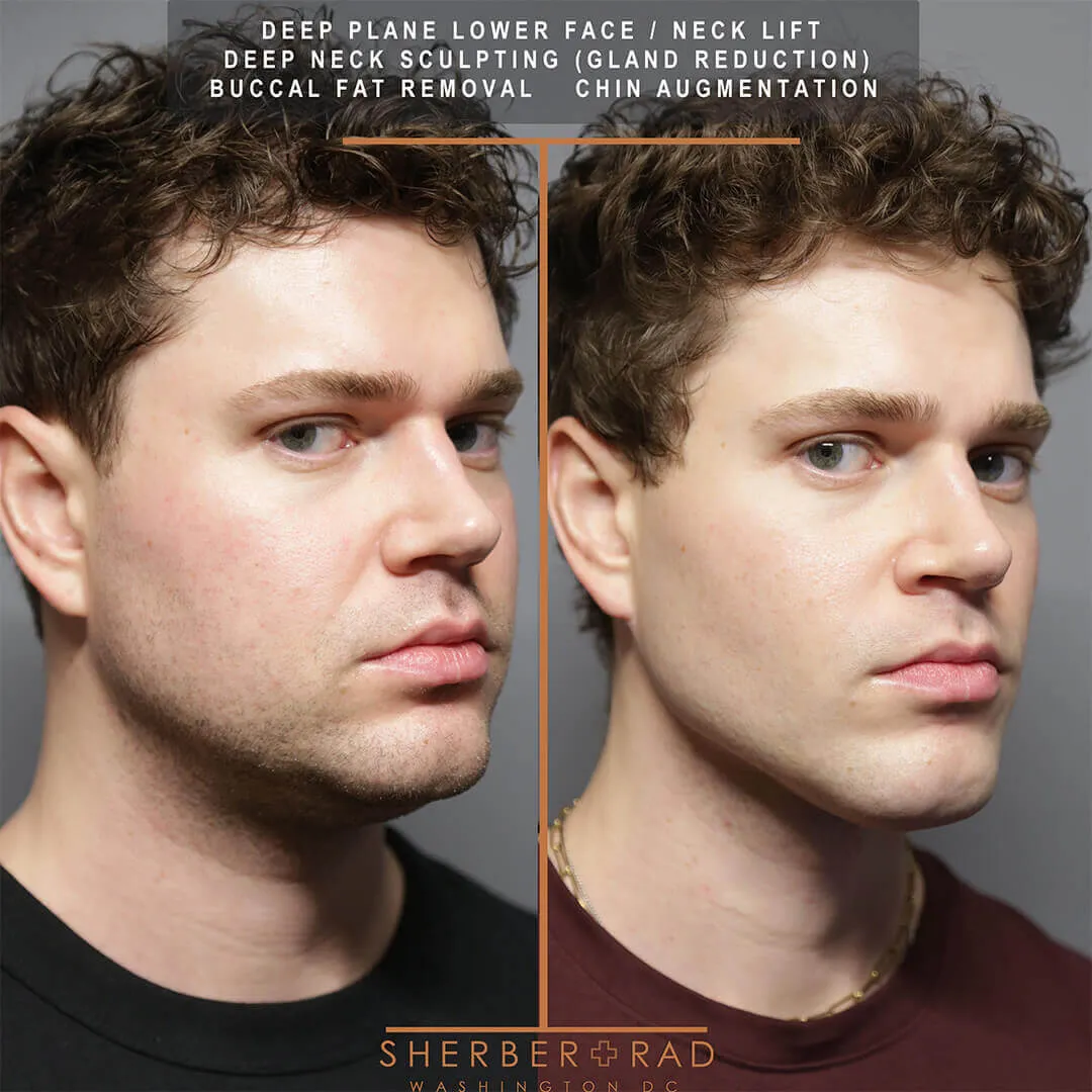 male facelift before and after photos by sherber and rad in washington dc