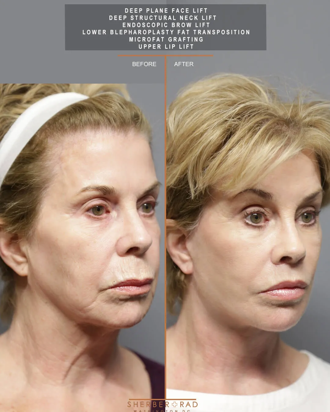 Facial Optimization before and after photos by Sherber and Rad in Washington
