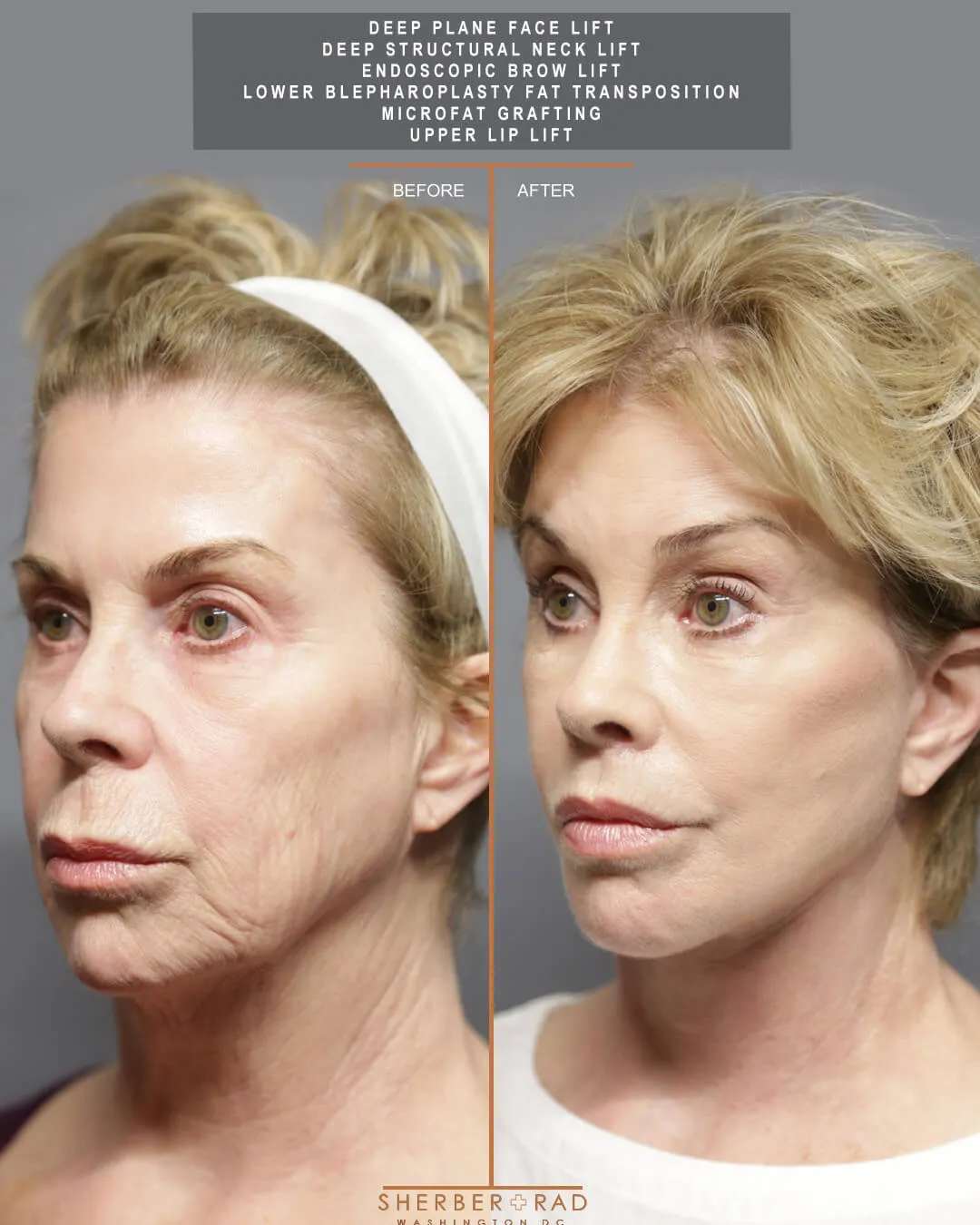 Facial Optimization before and after photos by Sherber and Rad in Washington