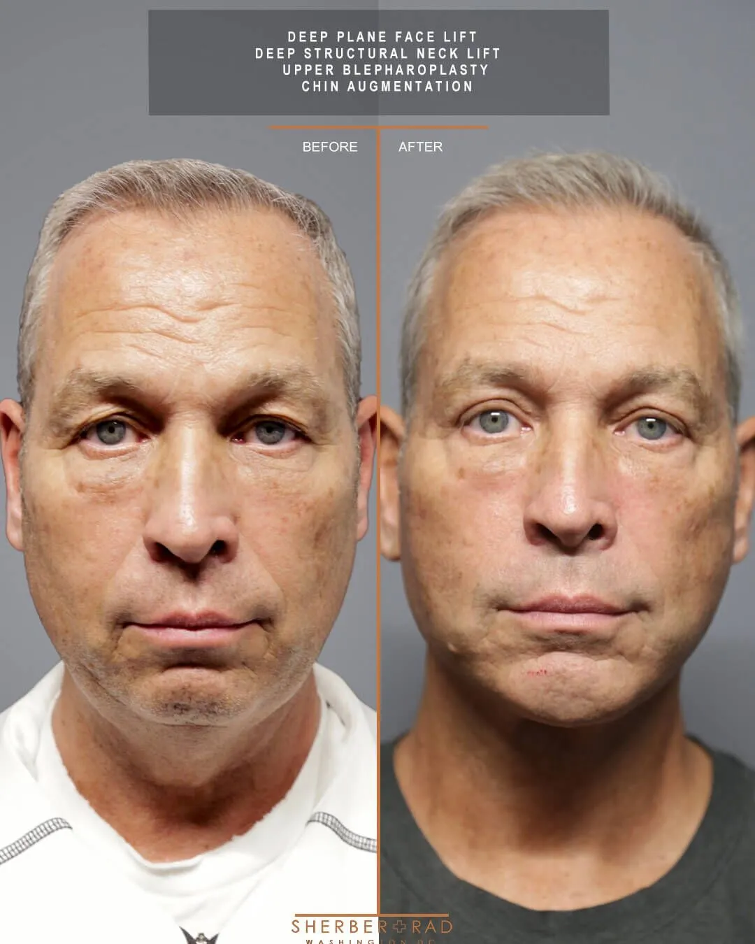 Male Facelift before and after photos by Sherber and Rad in Washington