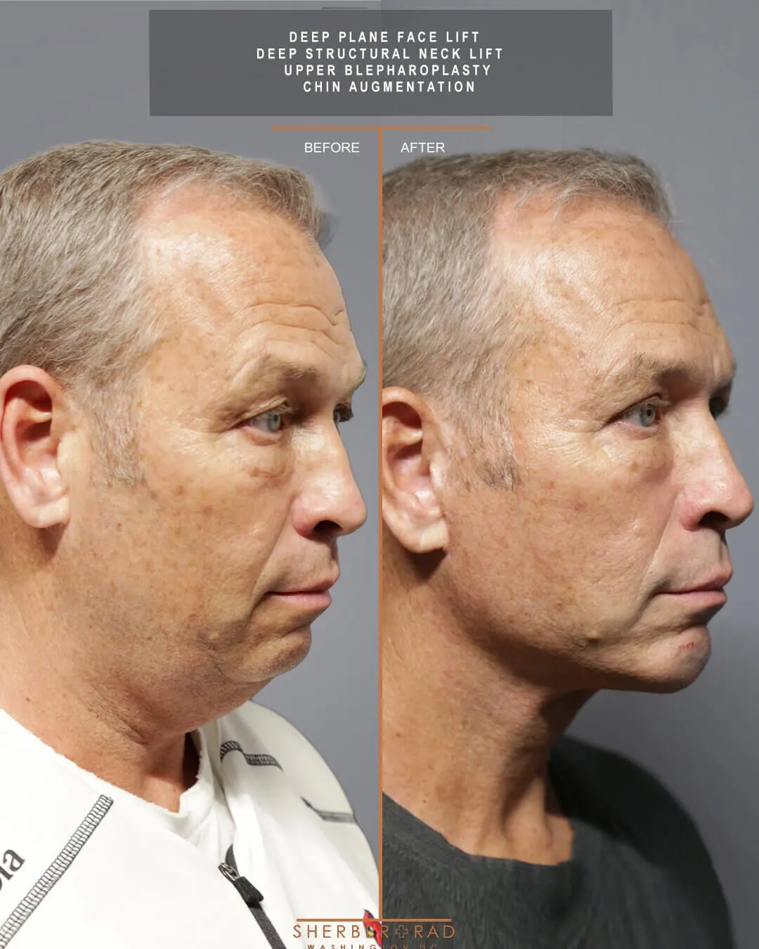 Male Facelift before and after photos by Sherber and Rad in Washington