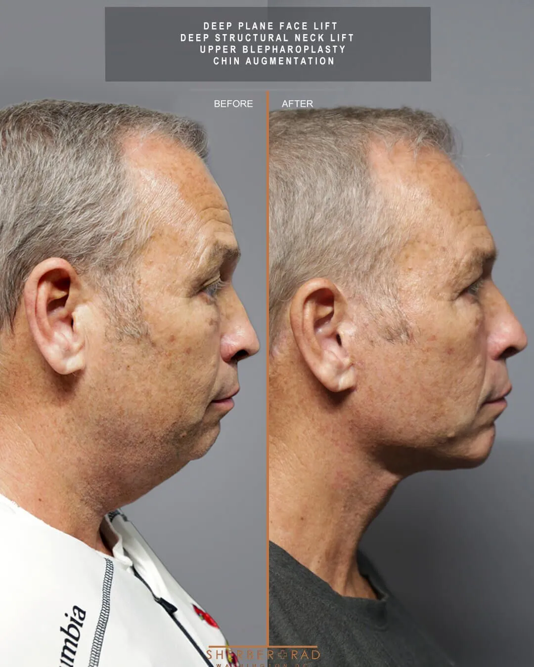 Male Facelift before and after photos by Sherber and Rad in Washington