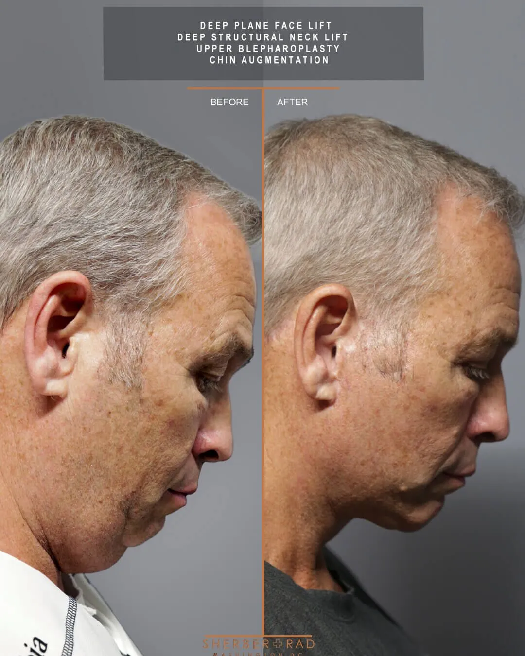Male Facelift before and after photos by Sherber and Rad in Washington
