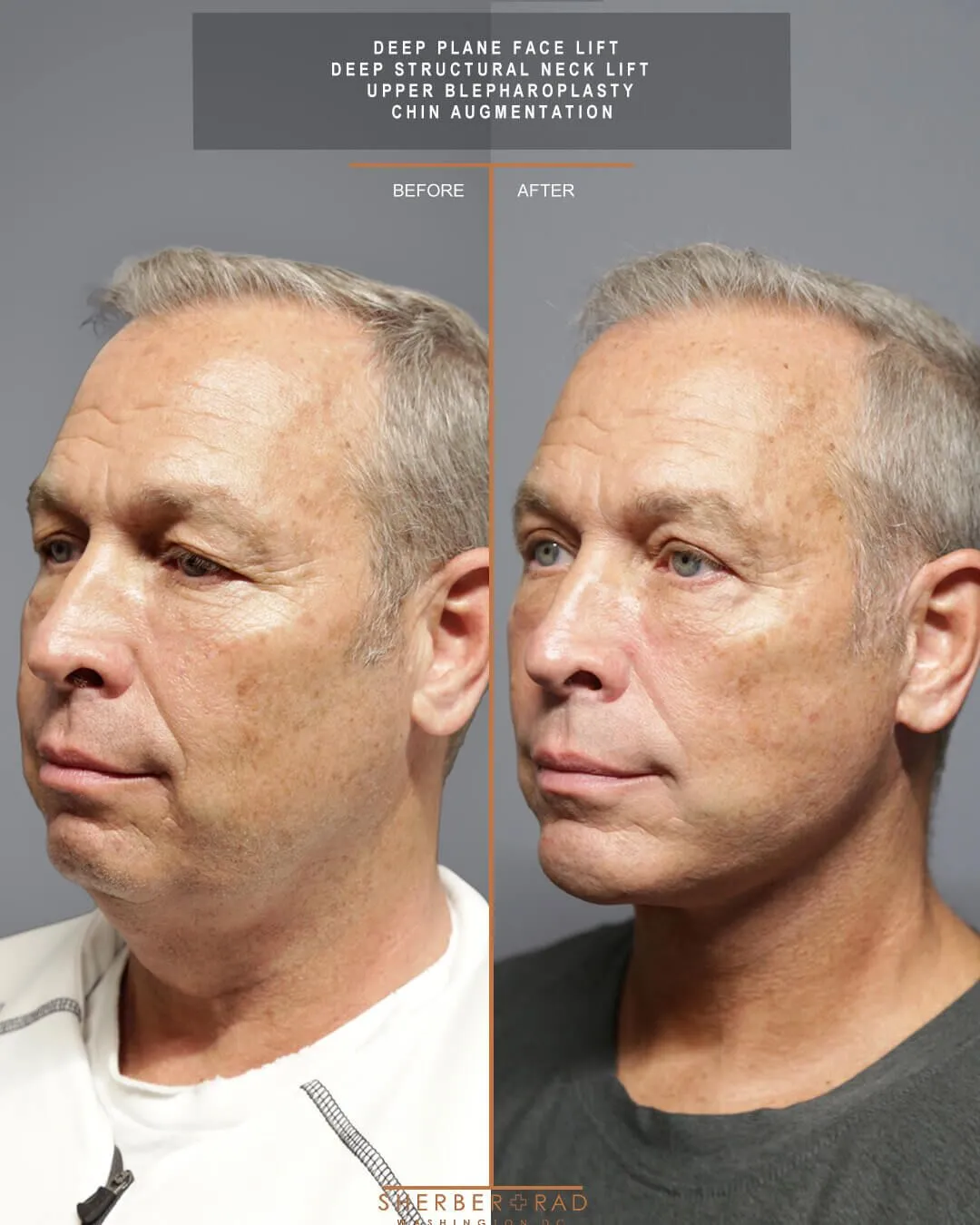 Male Facelift before and after photos by Sherber and Rad in Washington
