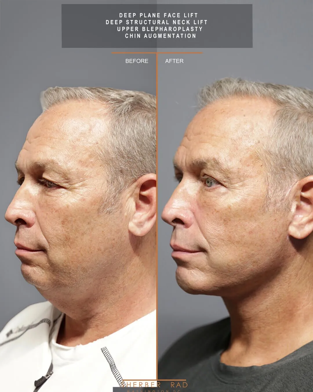 Male Facelift before and after photos by Sherber and Rad in Washington