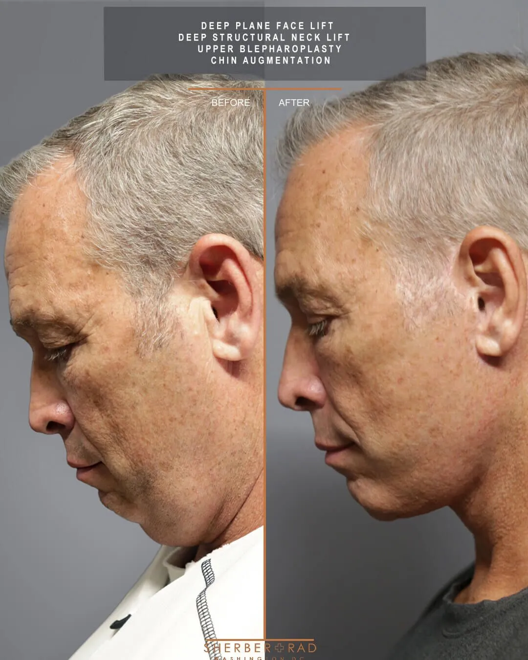 Male Facelift before and after photos by Sherber and Rad in Washington
