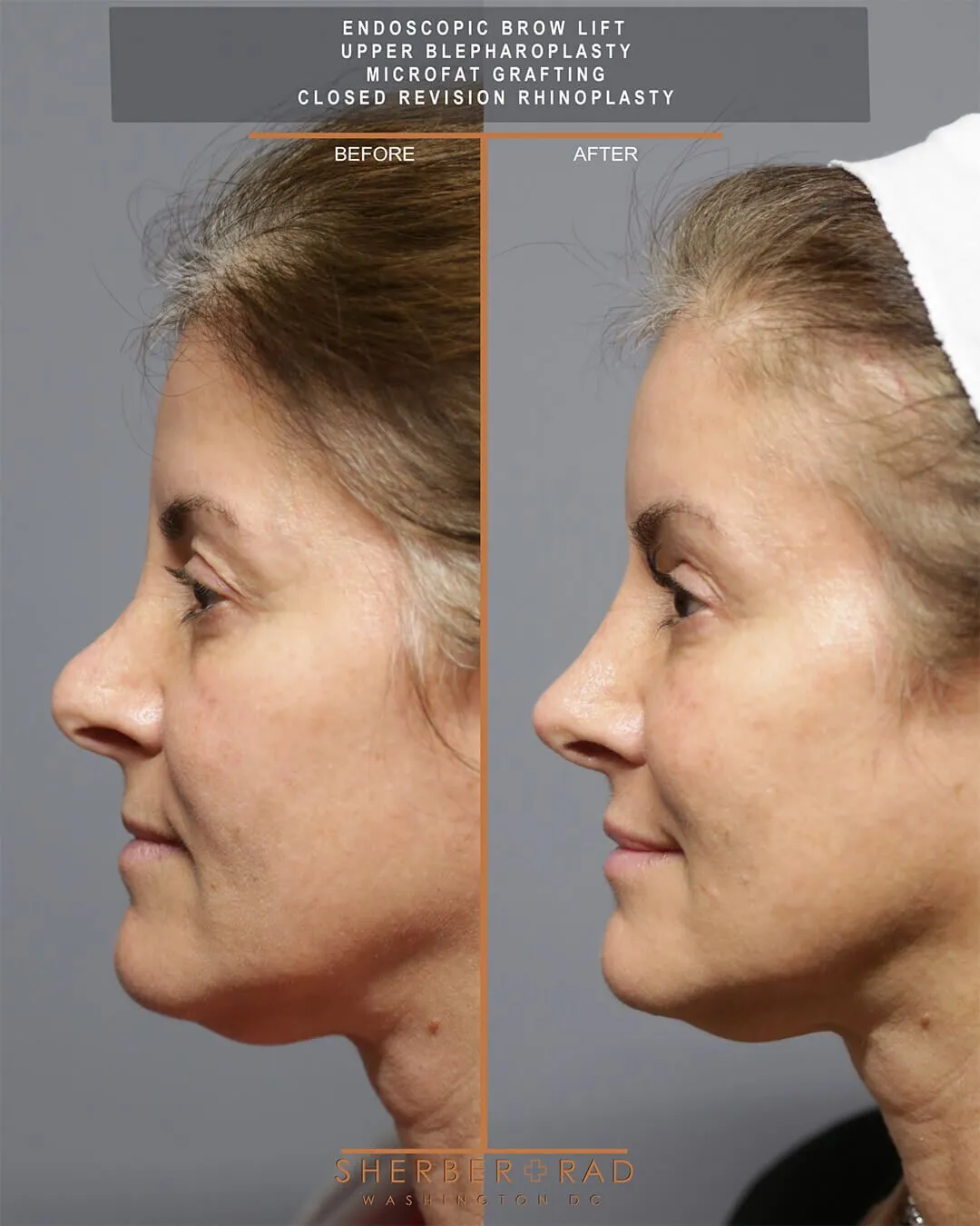 Brow Lift and Rhinoplasty before and after photos by Sherber and Rad in Washington DC