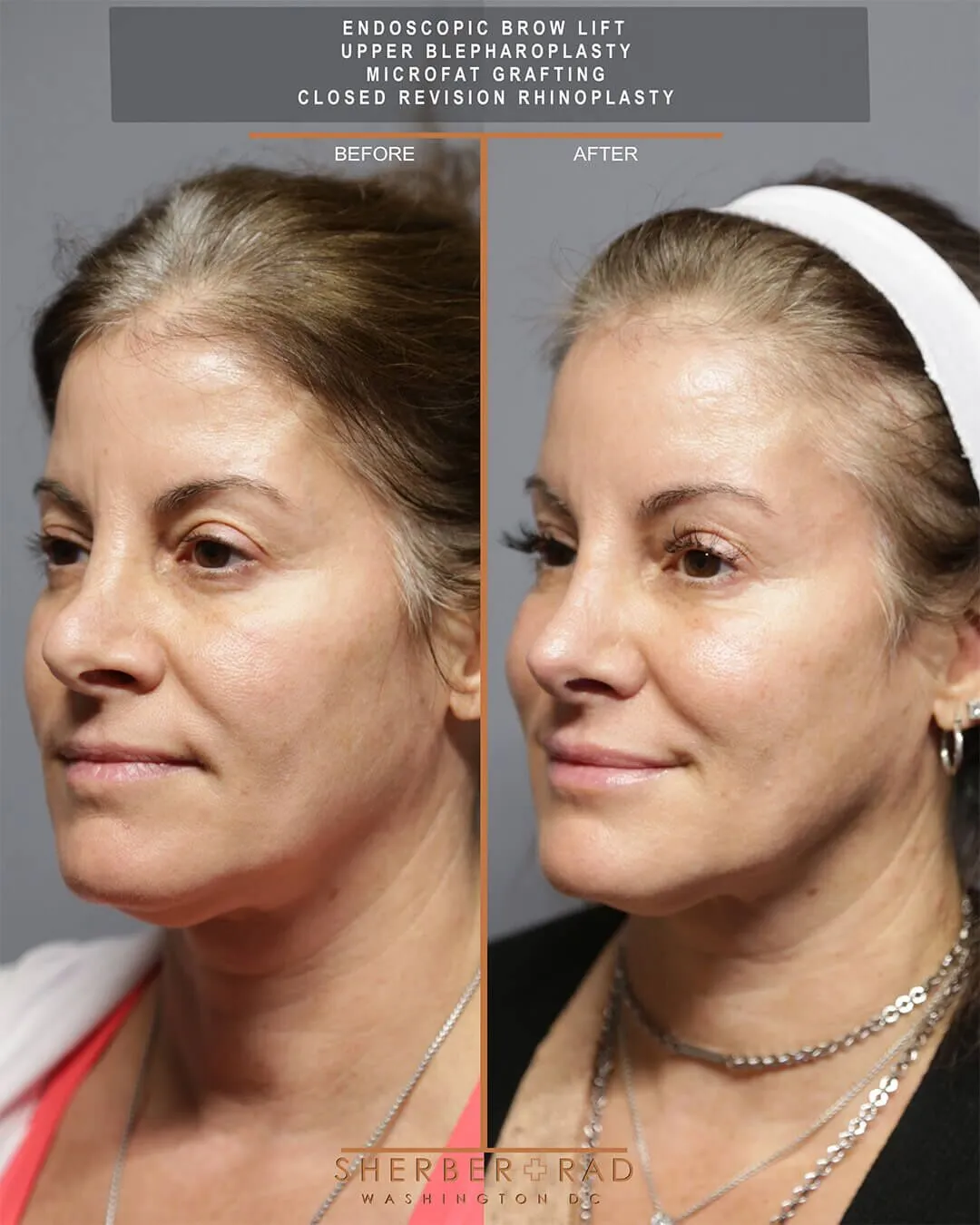 Brow Lift and Rhinoplasty before and after photos by Sherber and Rad in Washington DC