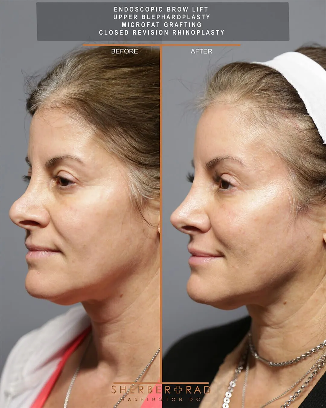 Brow Lift and Rhinoplasty before and after photos by Sherber and Rad in Washington DC