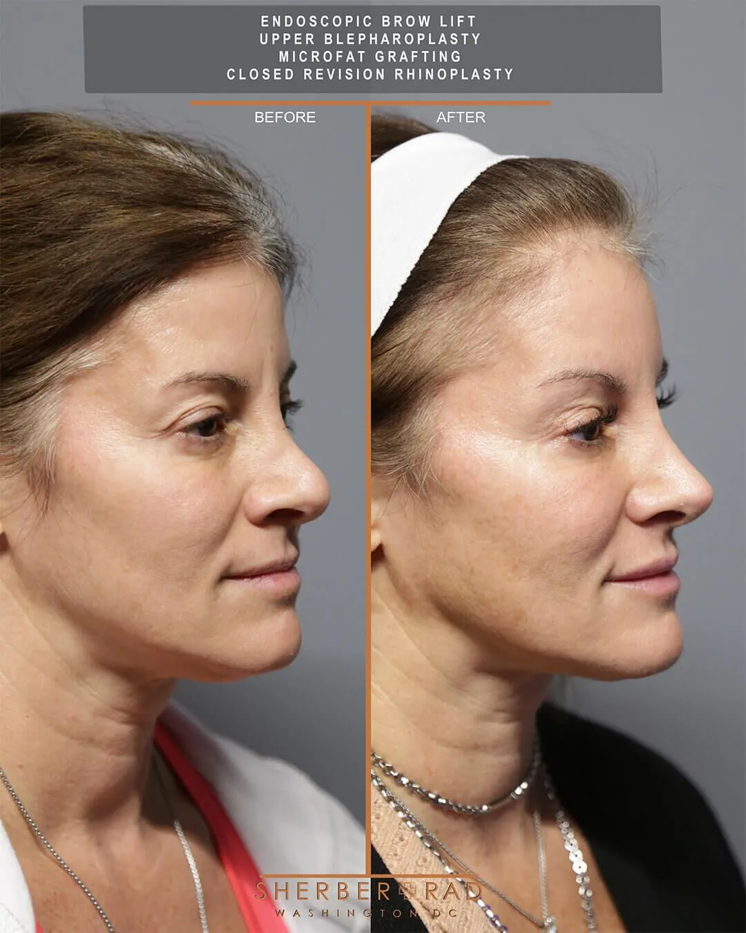 Brow Lift and Rhinoplasty before and after photos by Sherber and Rad in Washington DC