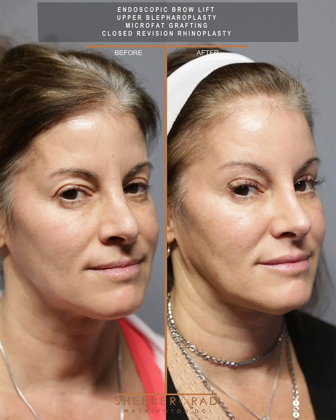 Brow Lift and Rhinoplasty before and after photos by Sherber and Rad in Washington DC