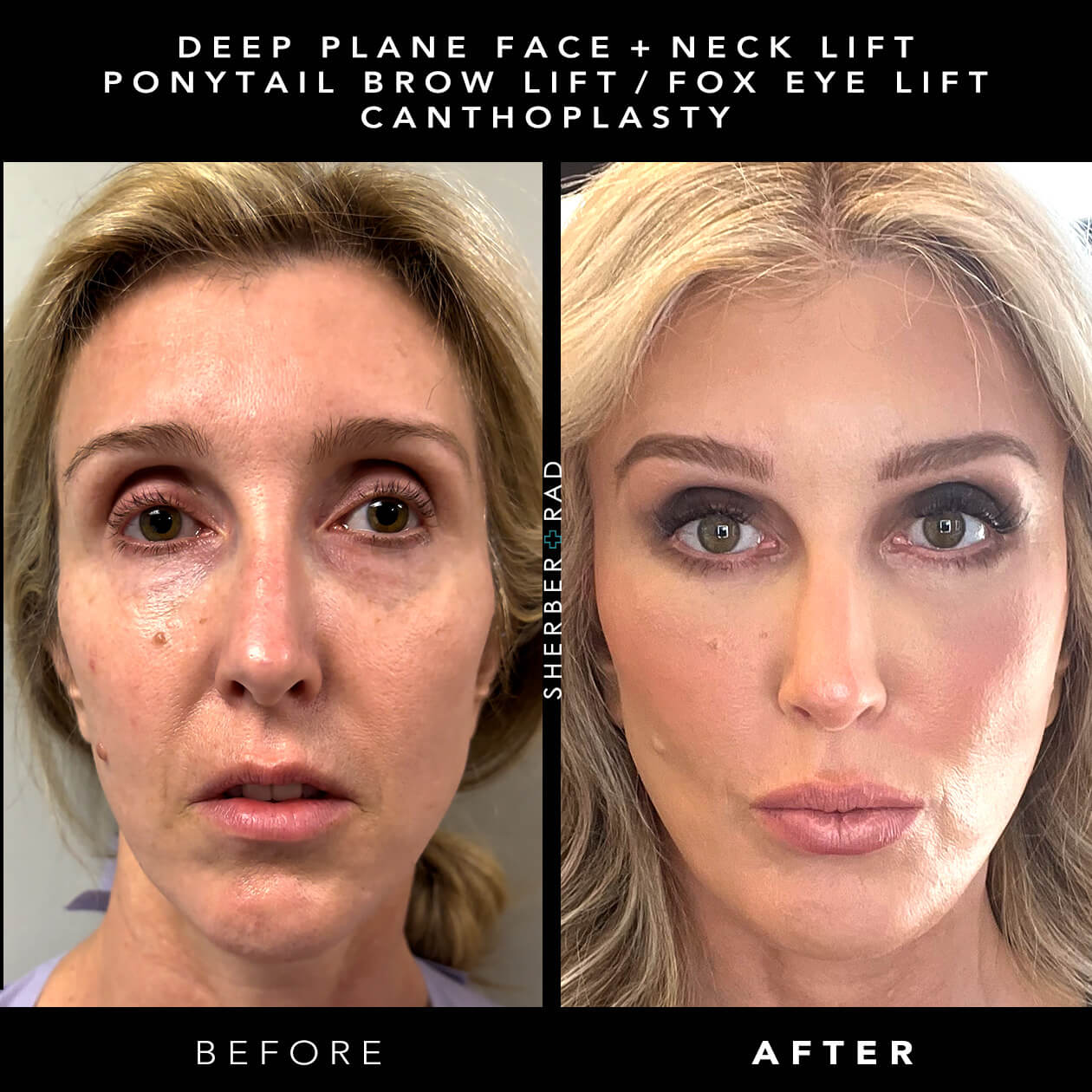 SMAS Facelift before and after photos by Sherber and Rad in Washington DC