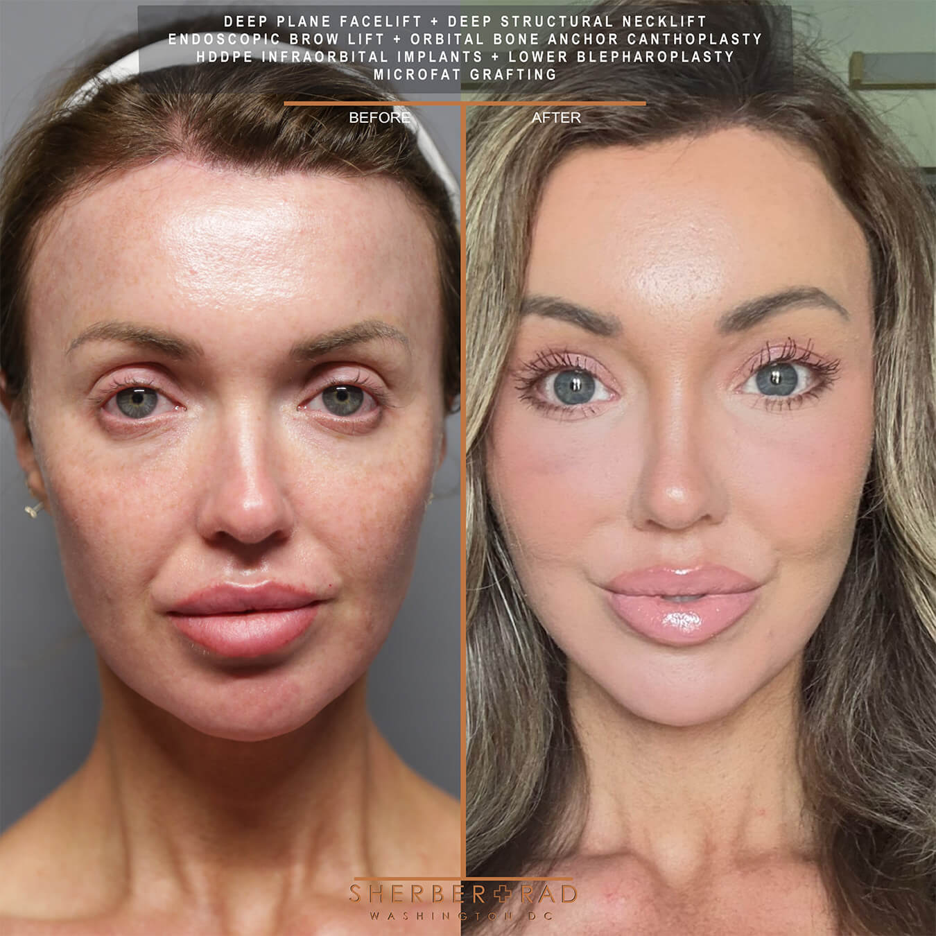 SMAS Facelift before and after photos by Sherber and Rad in Washington DC