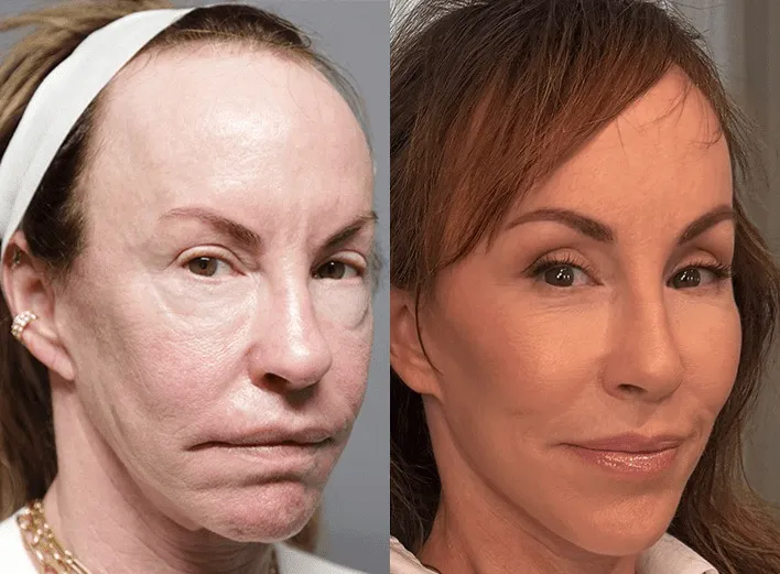 facelift browlift blepharoplasty fat grafting before and after photos by sherber and rad