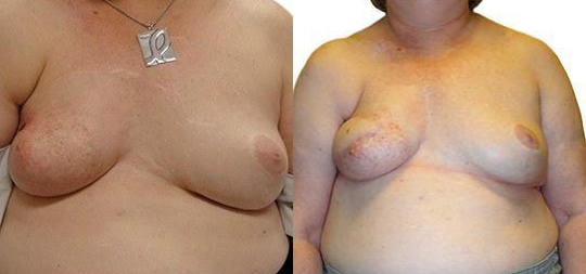 Lumpectomy Reconstruction before and after photos by Sherber and Rad in Washington, DC