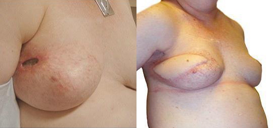 Lumpectomy Reconstruction before and after photos by Sherber and Rad in Washington, DC