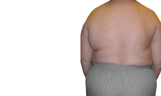 Lumpectomy Reconstruction before and after photos by Sherber and Rad in Washington, DC