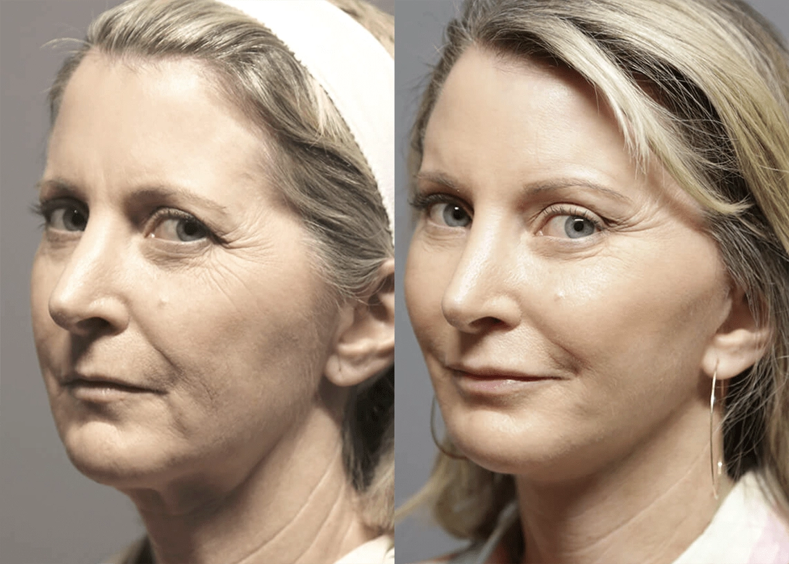 Facelift before and after photos by Sherber and Rad in Washington, DC