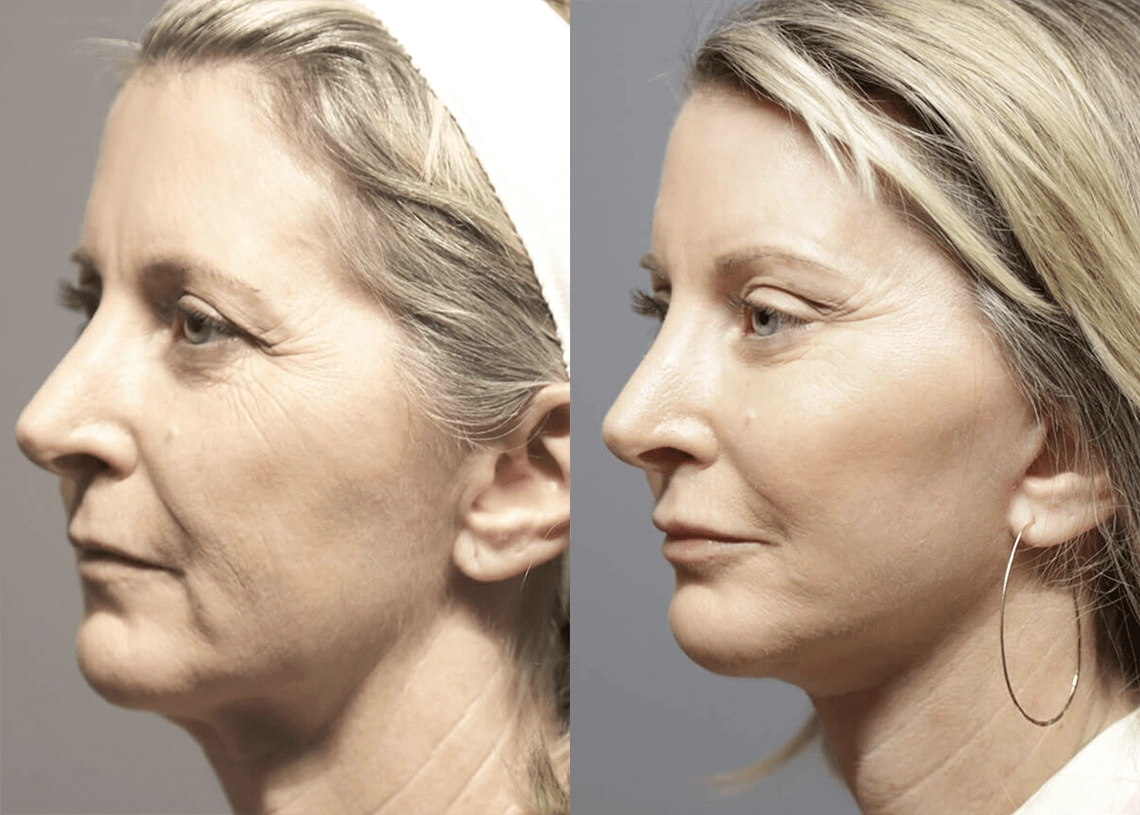Facelift before and after photos by Sherber and Rad in Washington, DC