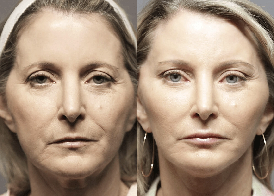 Facelift before and after photos by Sherber and Rad in Washington, DC