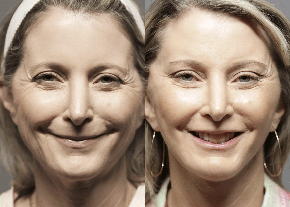 Facelift before and after photos by Sherber and Rad in Washington, DC