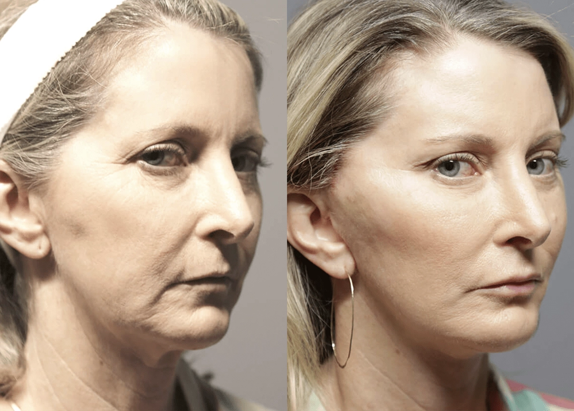Facelift before and after photos by Sherber and Rad in Washington, DC