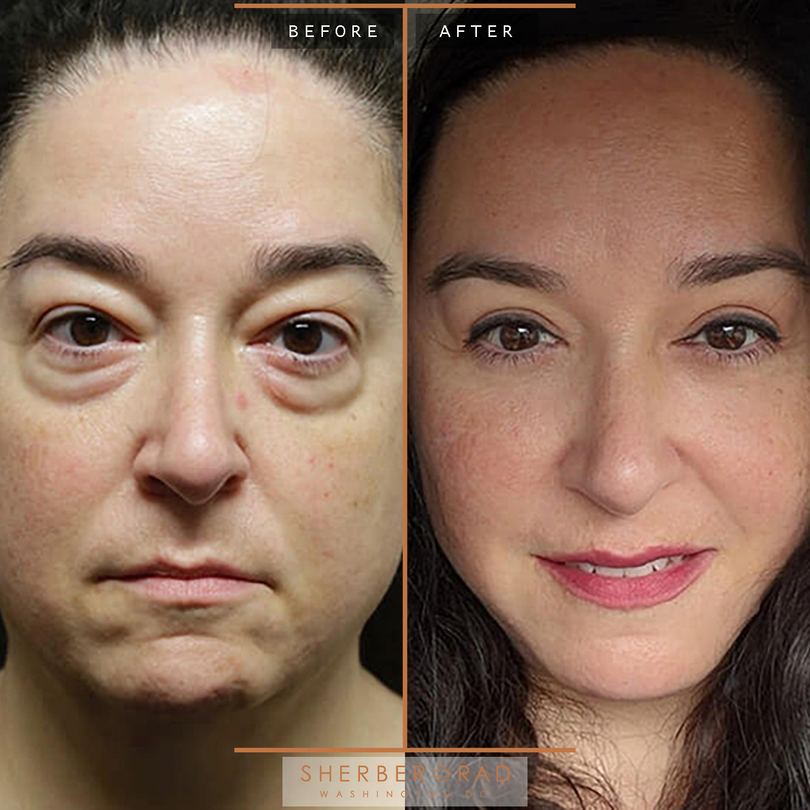 Facelift before and after photos by Sherber and Rad in Washington, DC
