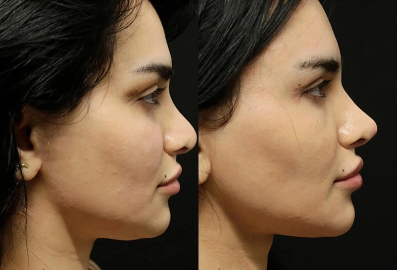 Facelift before and after photos by Sherber and Rad in Washington, DC