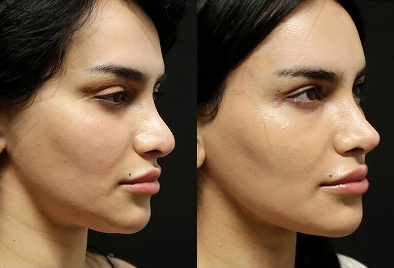 Facelift before and after photos by Sherber and Rad in Washington, DC