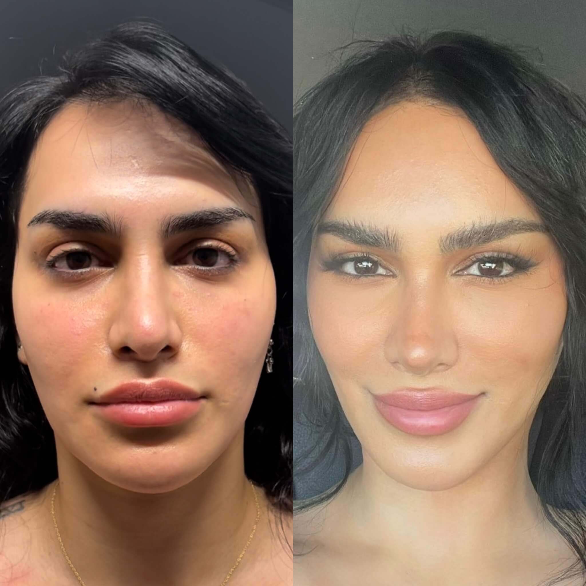 Facelift before and after photos by Sherber and Rad in Washington, DC