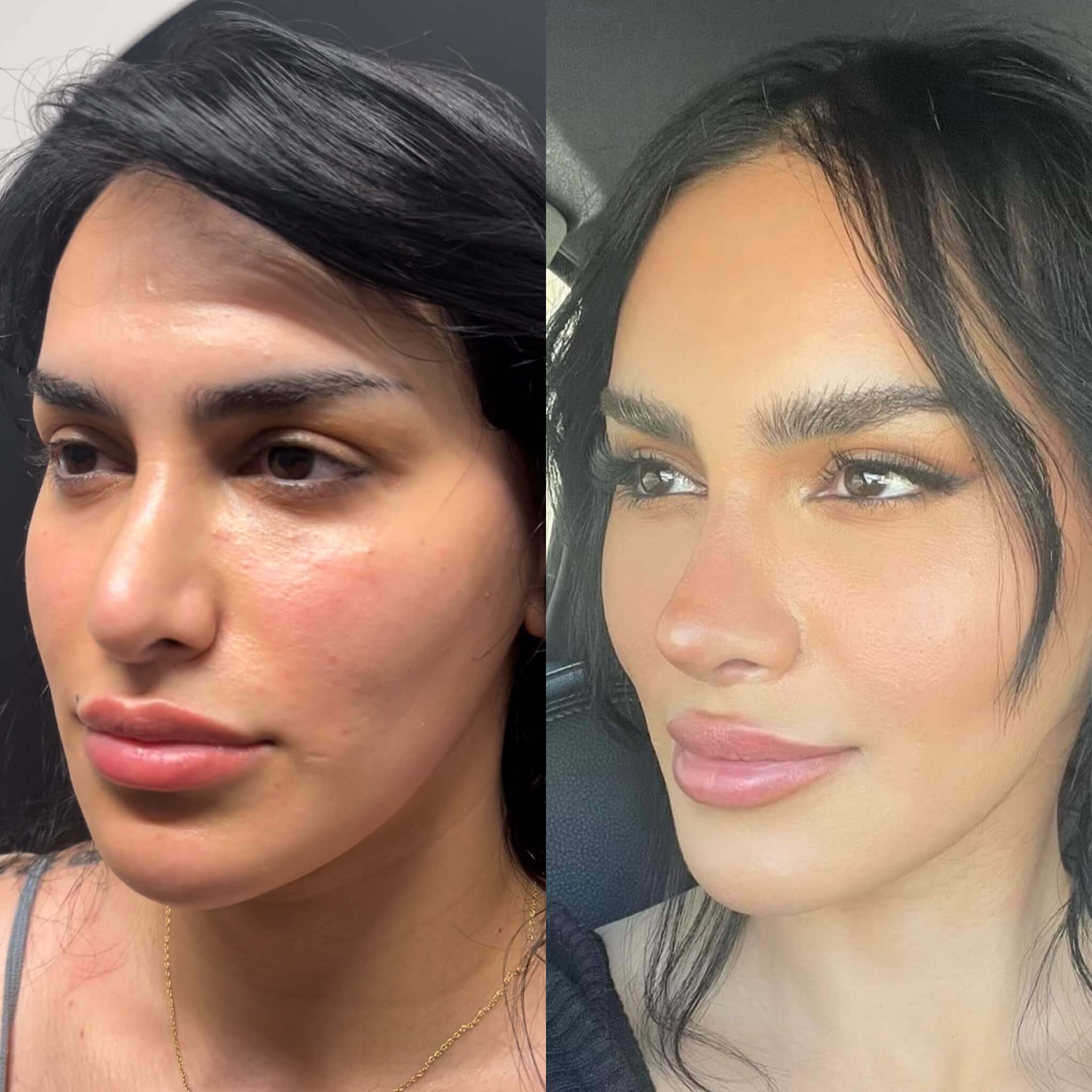 Facelift before and after photos by Sherber and Rad in Washington, DC