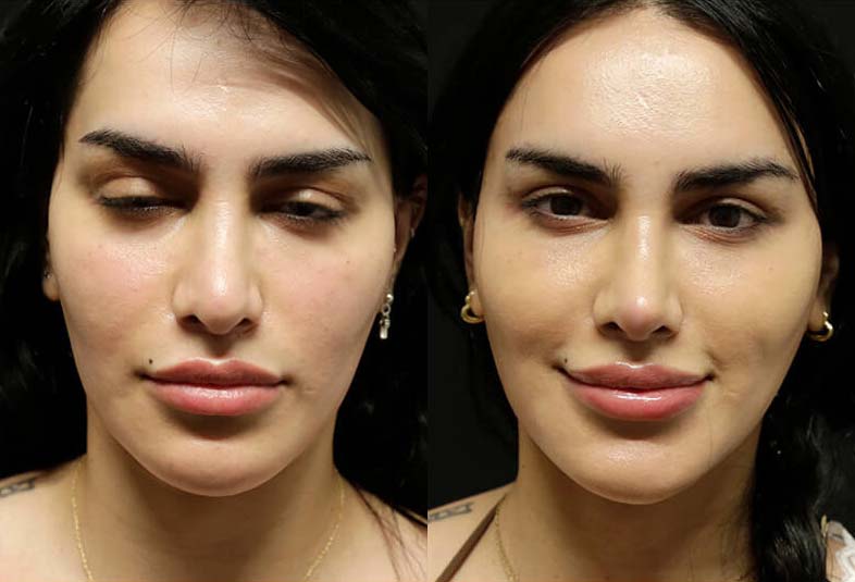 Facelift before and after photos by Sherber and Rad in Washington, DC