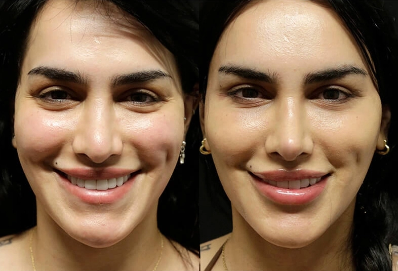 Facelift before and after photos by Sherber and Rad in Washington, DC