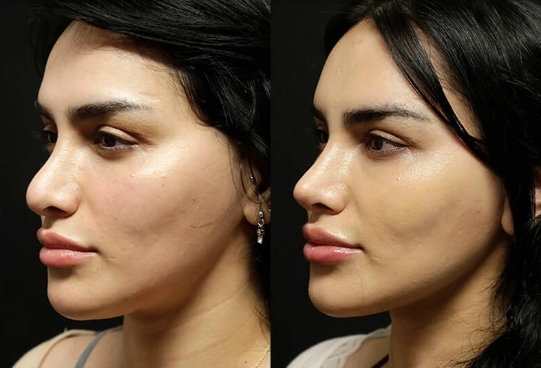 Facelift before and after photos by Sherber and Rad in Washington, DC