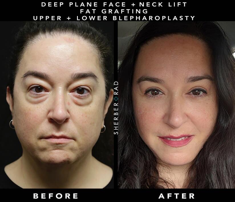 facelift before and after photos by sherber and rad in washington