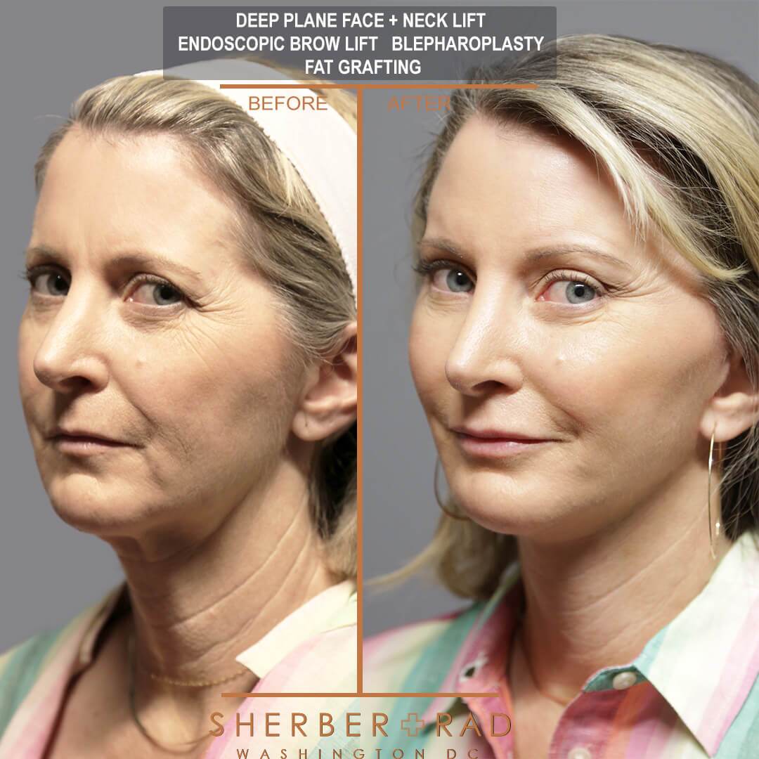 Facelift before and after photos by Sherber and Rad in Washington DC