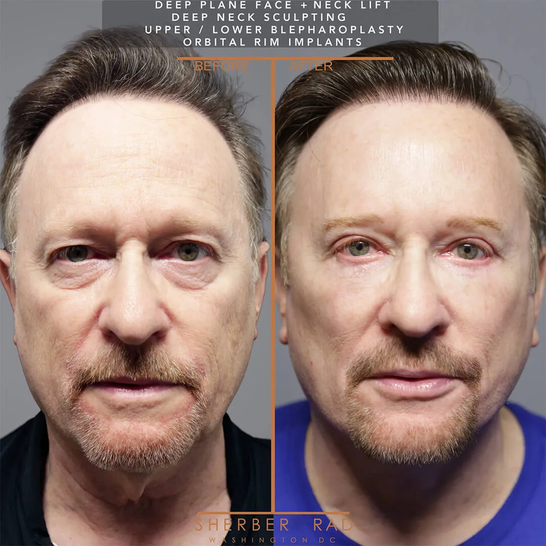Male Facelift before and after photos by Sherber and Rad in Washington DC