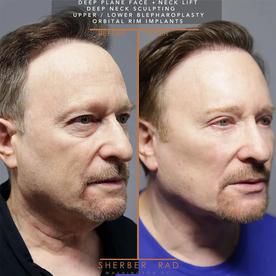 Male Facelift before and after photos by Sherber and Rad in Washington DC