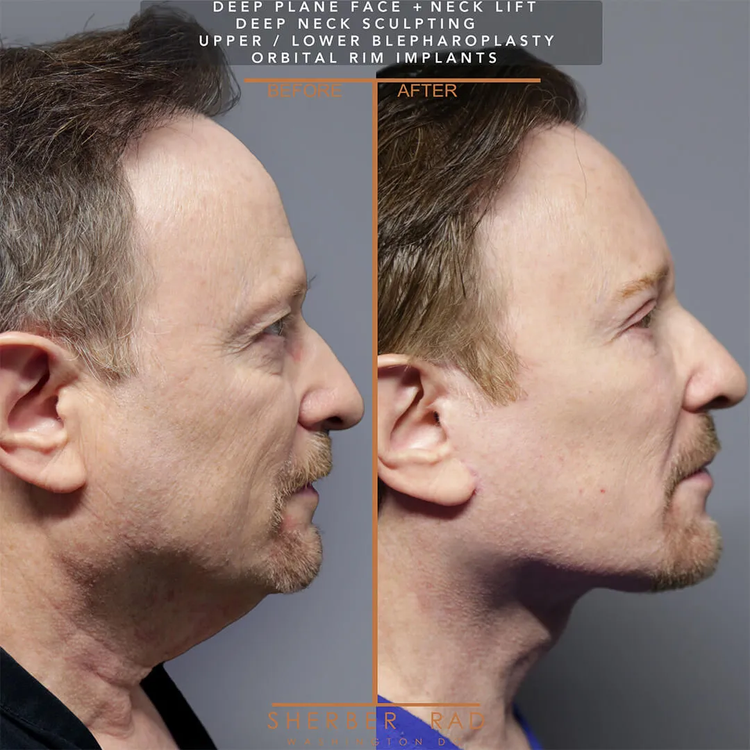 Male Facelift before and after photos by Sherber and Rad in Washington DC