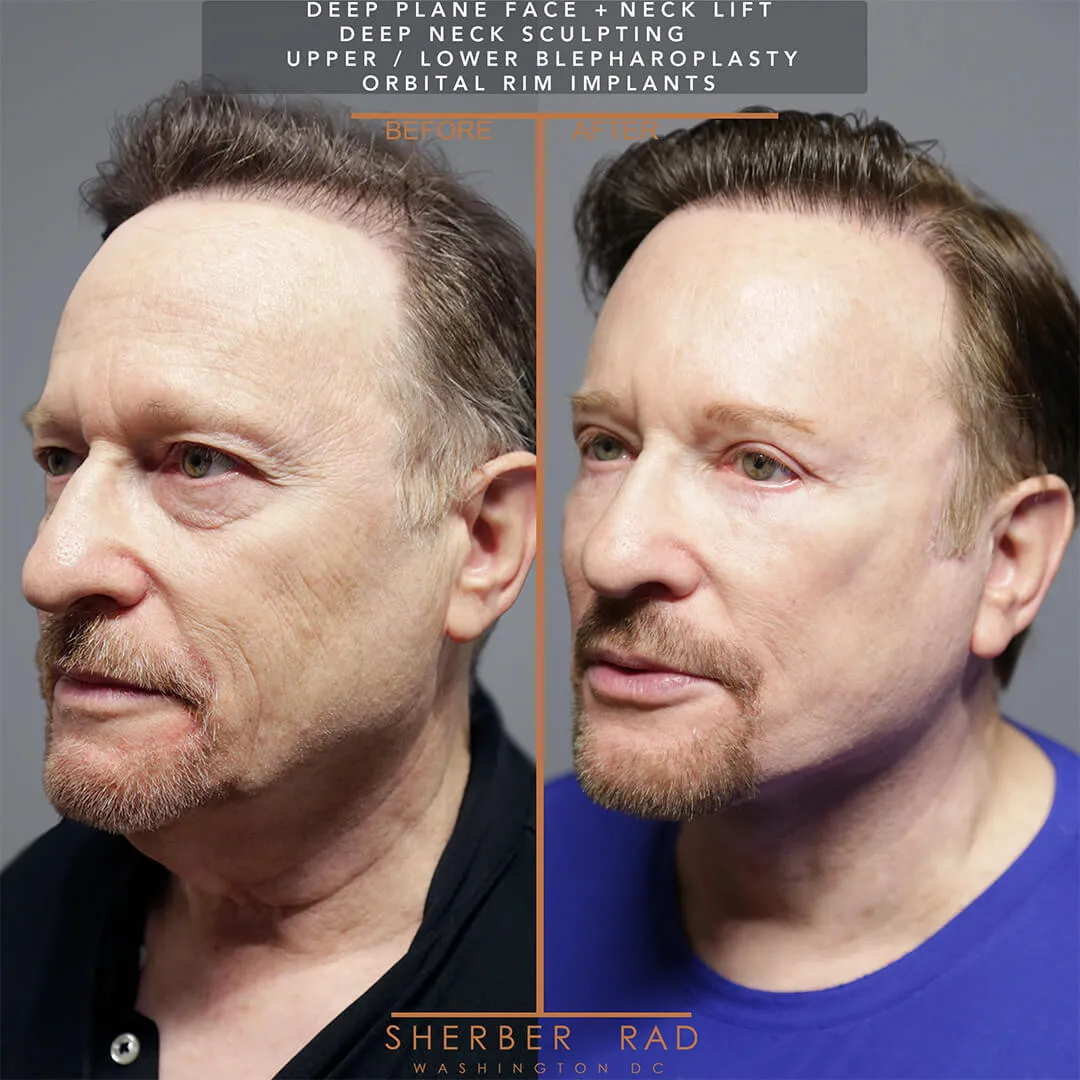 Male Facelift before and after photos by Sherber and Rad in Washington DC