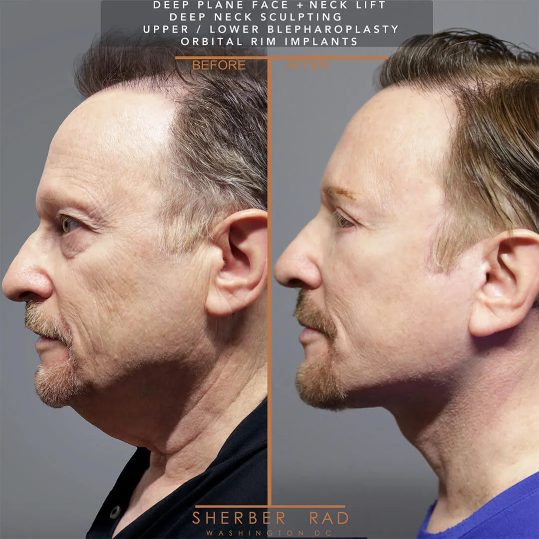 Male Facelift before and after photos by Sherber and Rad in Washington DC